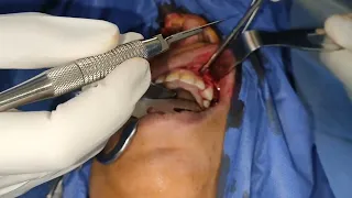 maxillary sinus cyst enucleation .