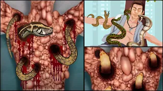 ASMR Treatment Removal Of Maggot & Snake Infected Back | Severely Injured Animation | Universe ASMR