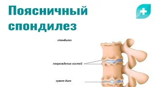 Поясничный спондилез: причины, симптомы и лечение