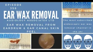 EAR WAX REMOVAL FROM EARDRUM & EAR CANAL SKIN PEEL - EP 358