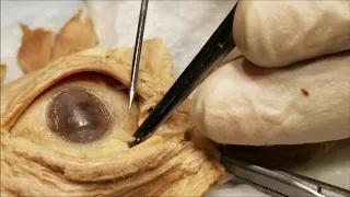 Exenterated Eyeball 1 – Conjunctival Dissection with Clinical Aspects – Sanjoy Sanyal