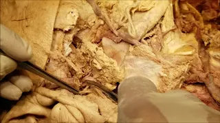 Facial Nerve HD Demonstration Within Parotid Gland - Sanjoy Sanyal