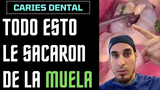 ¿Qué es todo esto que le sale de un AGUJETO en la MUELA? - CARIES DENTAL