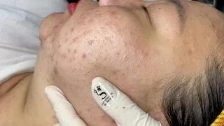 Acne Under The Skin | SacDepSpa#324