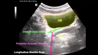 Stone at distal part of the ureter