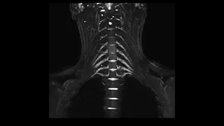 Brachial plexus MR Neurography using 3D HyperCube STIR with AIR Recon DL and Hyper Optima 450w 1.5T