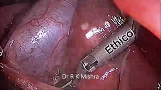 Laparoscopic Cholecystectomy for 5 Year Old Child