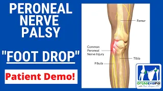 Peroneal Nerve Palsy with Foot Drop