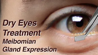 Dry Eyes Treatment with Meibomian Gland Expression (MGD)