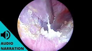 Infection causes ear to fill with dead skin (acute diffuse desquamation explained)