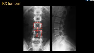 Anatomía Rx Simple Lumbar