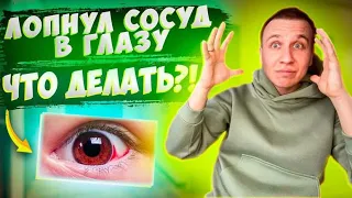 Лопнул сосуд в глазу / лопнул сосуд в глазу какие капли капать? / кровоизлияние в глазу что делать?