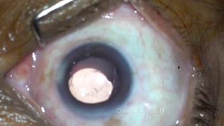 Intravitreal Injection Procedure