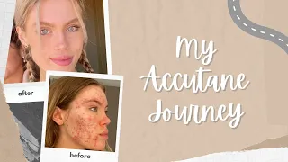 my accutane (isotretinoin) journey + honest experience (with pictures)