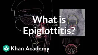 What is epiglottitis? | Respiratory system diseases | NCLEX-RN | Khan Academy