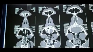 HOW TO READ A CT - PNS (Paranasal sinuses) made simple . Dr.Ajinkya Kedari