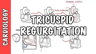 Tricuspid Regurgitation pathophysiology, investigation and treatment