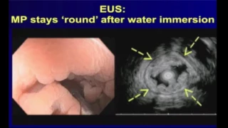 DDW 2016  Endoscopic Resection of Colonic Lesions EMR  Conventional Underwater and More HD