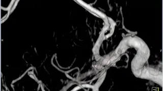 Эмболизация аневризм артерий головного мозга