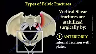 Pelvic Fracture Overview - Everything You Need To Know - Dr. Nabil Ebraheim