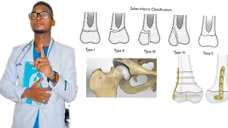SALTER HARRIS CLASSIFICATION OF FRACTURES AROUND THE GROWTH PLATE IN CHILDREN.
