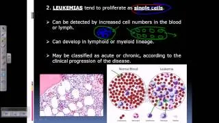 Leukemia and lymphoma