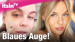 Unfall bei Dagi Bee: Blaues Auge wegen Söhnchen Nelio! | It's in TV