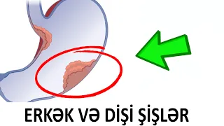Erkək və Dişi şişlər nədir? - Dr Elşən Qədimov