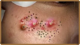 Extreme Blackhead Removal at LNG Skin Care #039