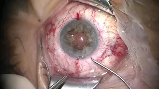 Pupilloplasty in combination to a femto-cataract-surgery for a traumatic cataract and mydriasis