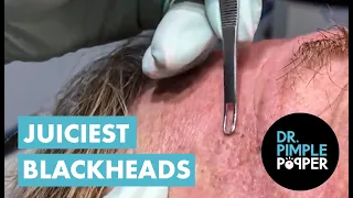 Juicy Blackheads Extracted by Dr Pimple Popper