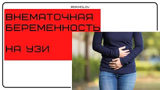 Внематочная беременность на УЗИ органов малого таза(Ectopic pregnancy)