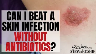 How I Pulled Out all the Stops to Avoid Antibiotics for a Skin Infection