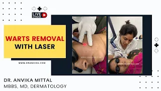 Warts Removal with laser by Dr. Anvika - www.DrAnvika.com