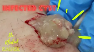 Infected Cyst Treatment. Dr Khaled Sadek. LipomaCyst.com