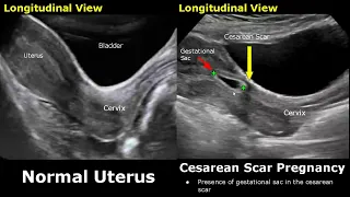 C-Section Uterus Ultrasound Normal Vs Abnormal Image Appearances | Cesarean Scar Complications USG