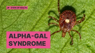 Tick Bites and Red Meat Allergy: The Rising Trend of Alpha-Gal Syndrome