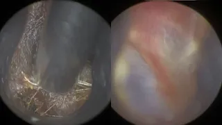 103 - Dry Matted Ear Wax Removal with WAXscope®️