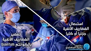 تصغير الغضاريف الأنفية (بجهاز الكوانتم) مقارنته استئصال الغضارف جراحيا د محمد البنهاوى أنف و أذن