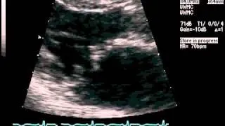 Echocardiography Showing Turbulent Flow at the Mitral Valve