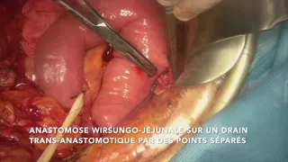 Modified blumgart Anastomosis for Pancreaticojejunostomy