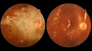 Cirugía de desprendimiento de Retina por Diabetes | Vitrectomía en diabéticos | Retina Tijuana