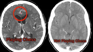 This Is What Happens To Your Brain _ Playing Chess!