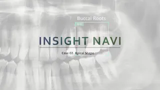 Vatech PaX-i Insight - Insight NAVI | Profundidade adicionada à panorâmica