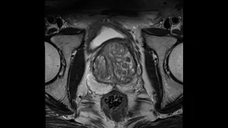 Introduction to Prostate MRI and PI-RADS: Approach and Principles