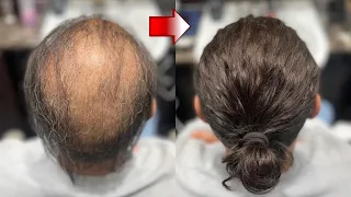 These BALDING to LONG HAIR Look TRANSFORMATIONS Are MIND BLOWING!