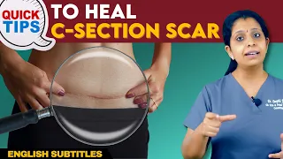 Quick Tips To Heal C-Section Scar | சிசேரியன் வடுக்களை எளிதில் எப்படி அகற்றுவது?