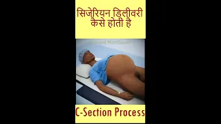 Cesarean Delivery kaise hoti hai | सिजेरियन डिलीवरी कैसे होती है #youtubeshorts  #cesareandelivery