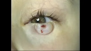 Incision and Drainage of an External Chalazion