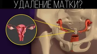 Как удаляют матку? Гистерэктомия | ПОЛЕЗНЫЙ ЮТУБ